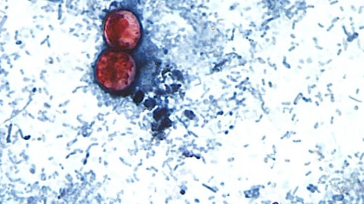 Cyclospora outbreak, a silent heart danger and what soccer may do to the brain